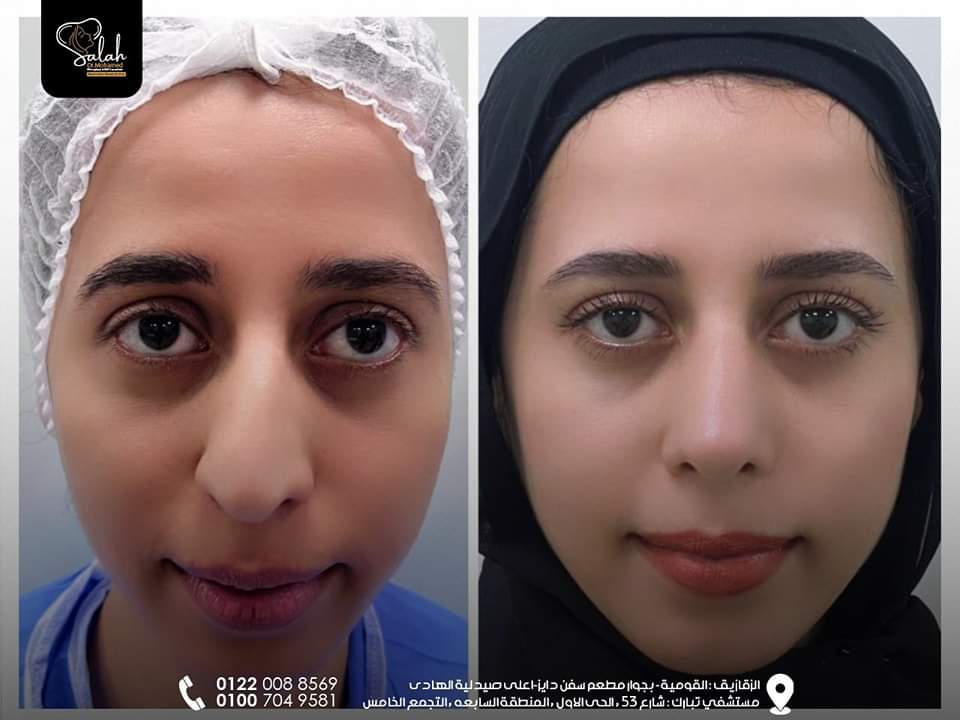 Crooked Nose Rhinoplasty